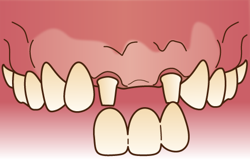 中台歯科医院 入れ歯・ブリッジ・インプラント メタルボンドブリッジ