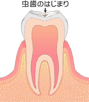 虫歯治療　c0