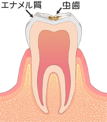 虫歯治療　c1