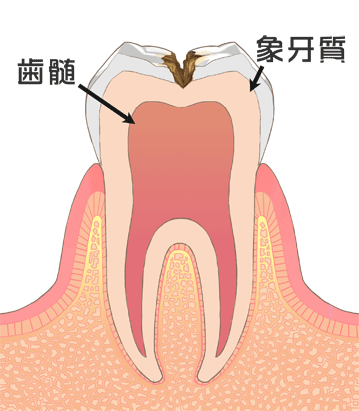 虫歯治療　c2