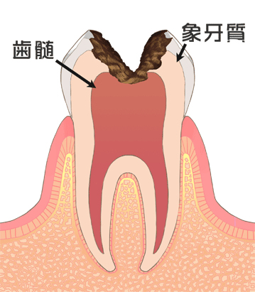 虫歯治療　c3