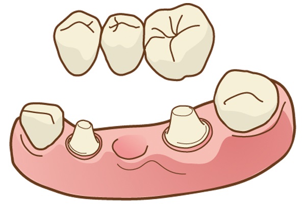 中台歯科医院 入れ歯・ブリッジ・インプラント ジルコニア
